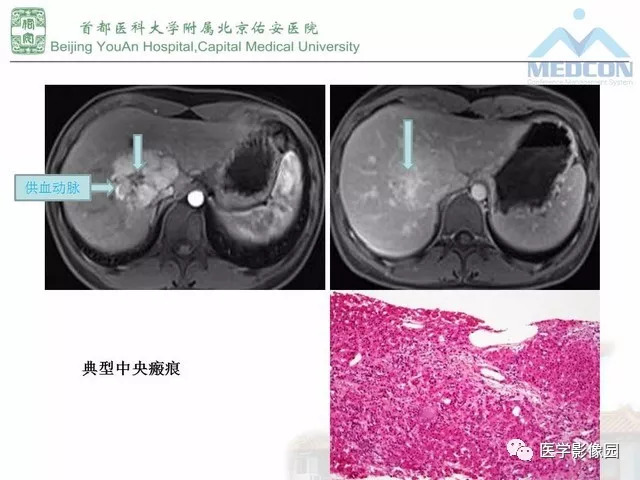 【PPT】肝脏少见良性肿瘤及肿瘤样病变影像诊断