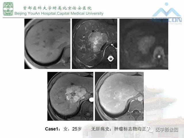 【PPT】肝脏少见良性肿瘤及肿瘤样病变影像诊断