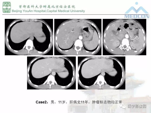 【PPT】肝脏少见良性肿瘤及肿瘤样病变影像诊断
