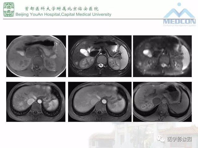 【PPT】肝脏少见良性肿瘤及肿瘤样病变影像诊断