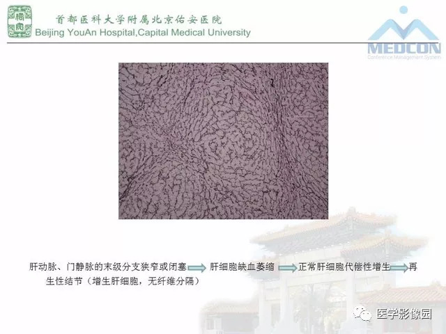【PPT】肝脏少见良性肿瘤及肿瘤样病变影像诊断