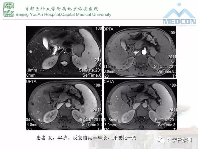 【PPT】肝脏少见良性肿瘤及肿瘤样病变影像诊断