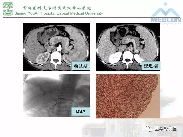 【PPT】肝脏少见良性肿瘤及肿瘤样病变影像诊断