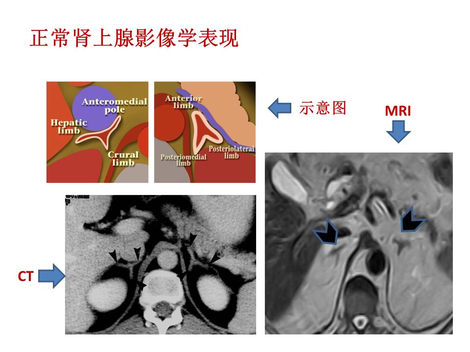 【PPT】肾上腺常见疾病的影像学表现