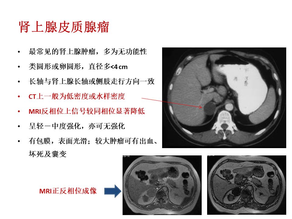 【PPT】肾上腺常见疾病的影像学表现