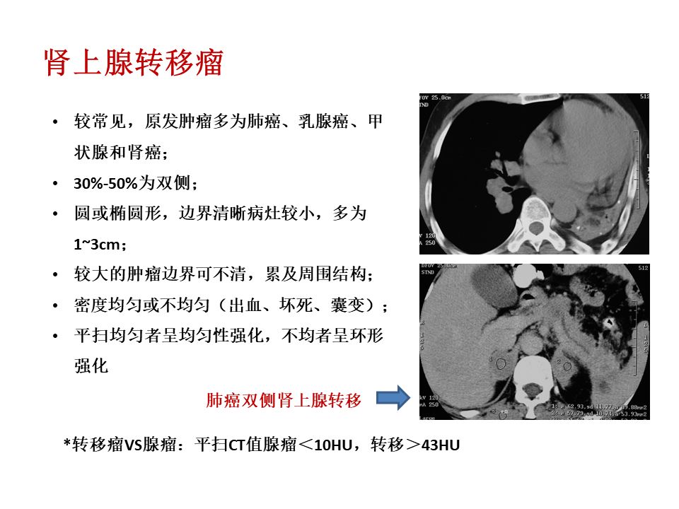 【PPT】肾上腺常见疾病的影像学表现