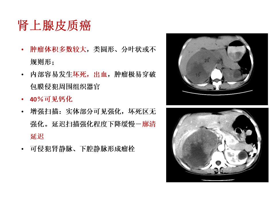 【PPT】肾上腺常见疾病的影像学表现