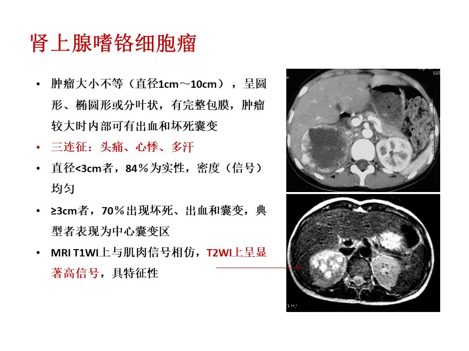 【PPT】肾上腺常见疾病的影像学表现