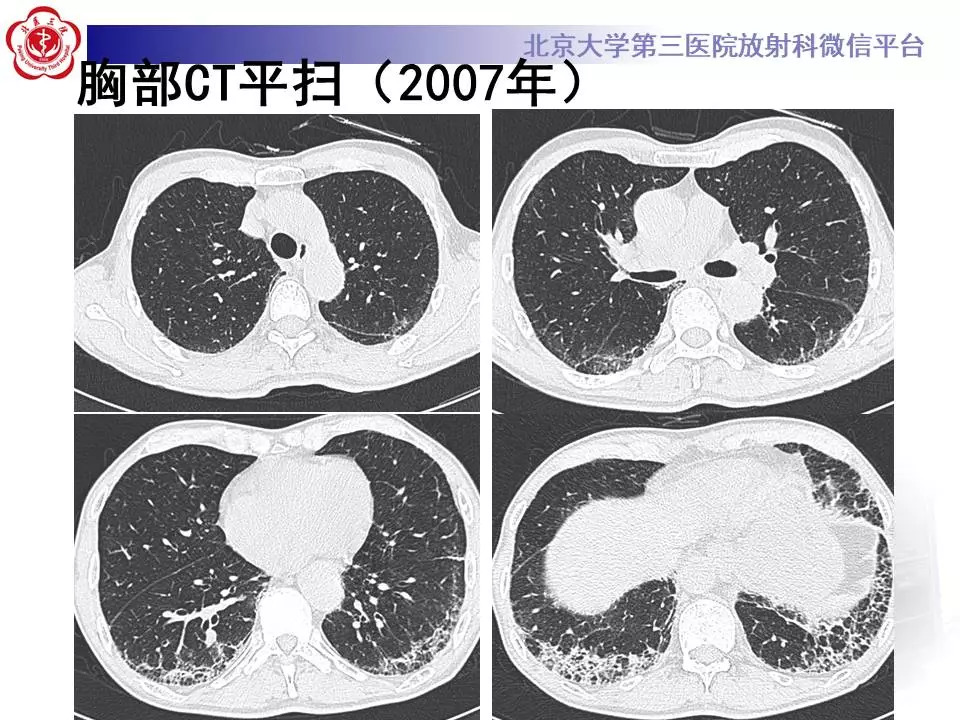 【病例】干燥综合征相关寻常型间质性肺炎1例CT影像表现