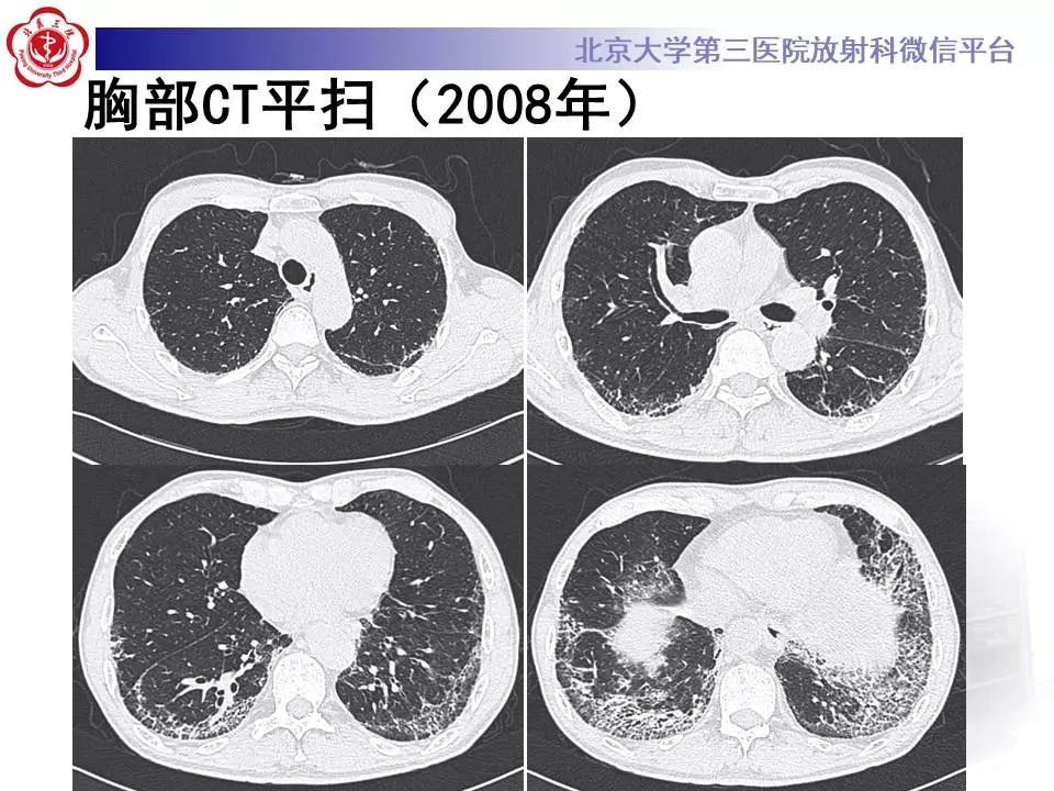 【病例】干燥综合征相关寻常型间质性肺炎1例CT影像表现