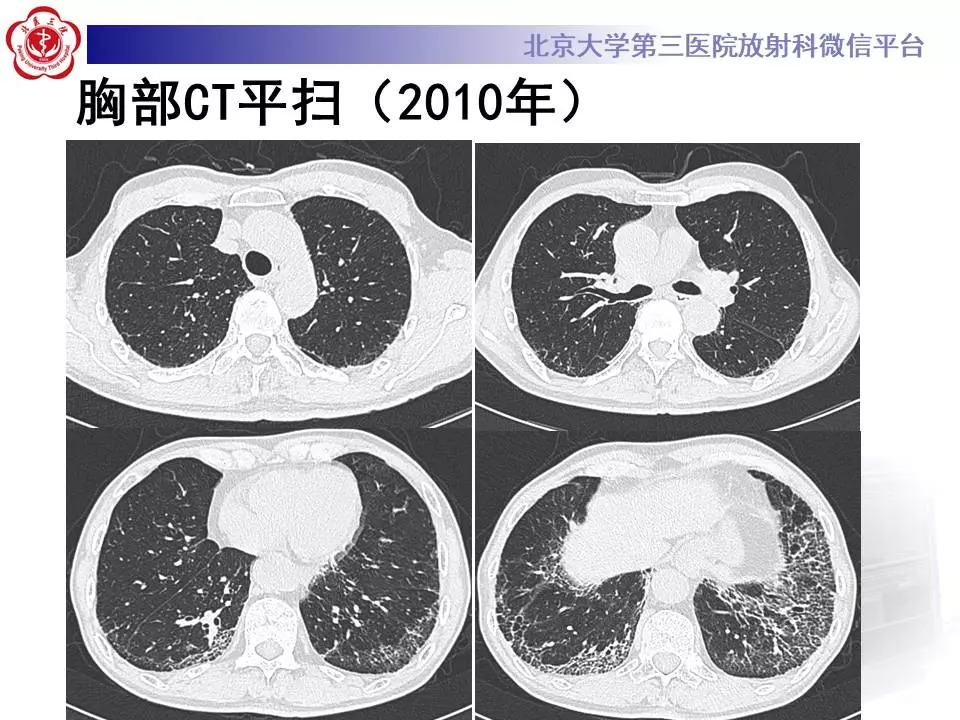 【病例】干燥综合征相关寻常型间质性肺炎1例CT影像表现