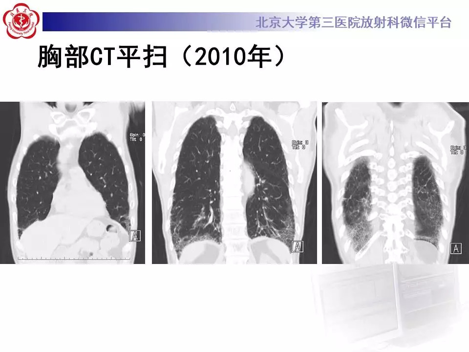【病例】干燥综合征相关寻常型间质性肺炎1例CT影像表现