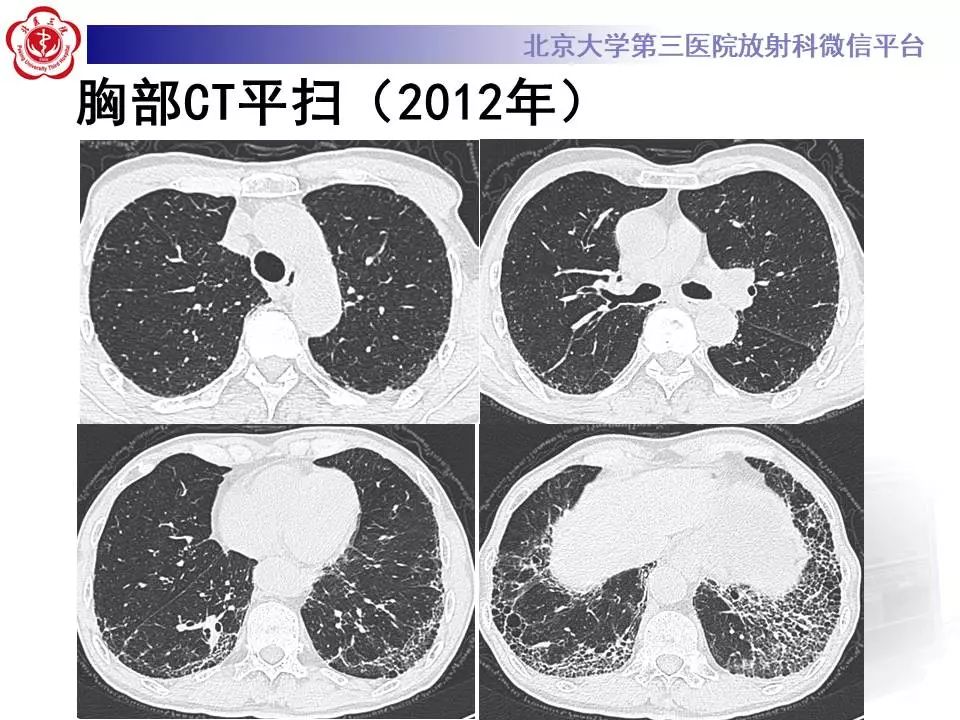 【病例】干燥综合征相关寻常型间质性肺炎1例CT影像表现