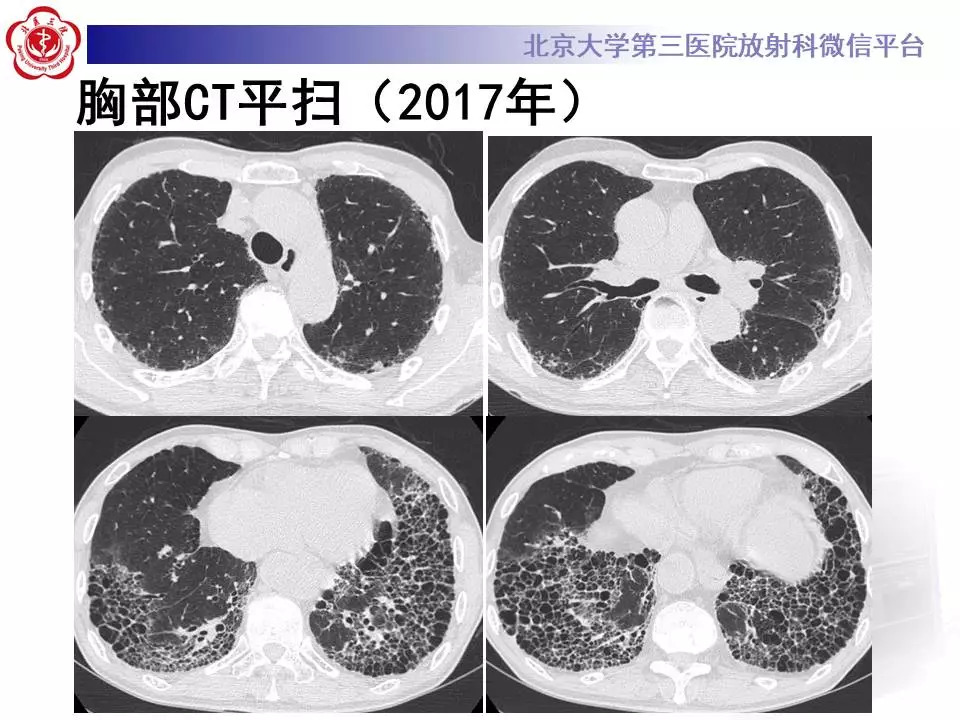 【病例】干燥综合征相关寻常型间质性肺炎1例CT影像表现