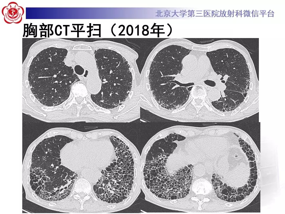 【病例】干燥综合征相关寻常型间质性肺炎1例CT影像表现