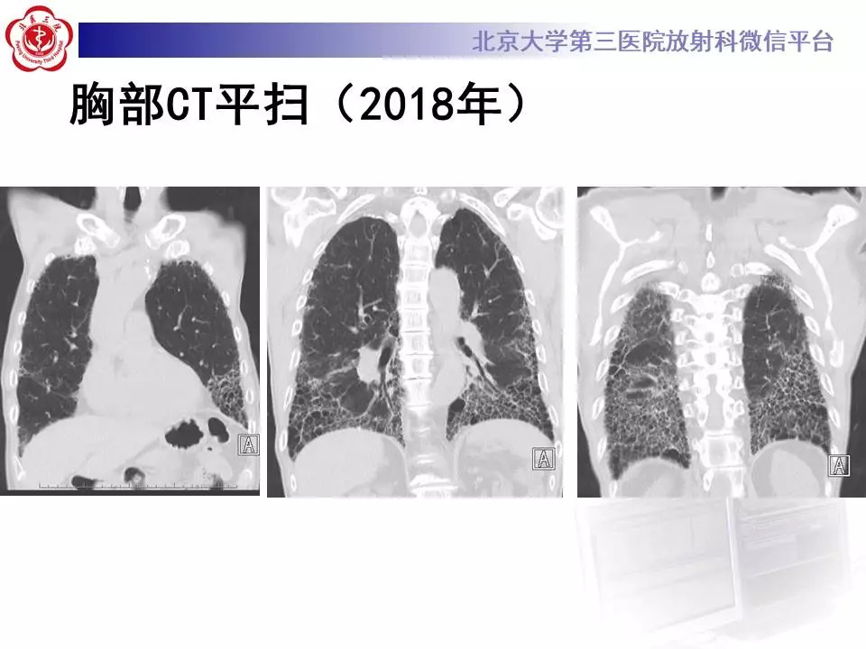 【病例】干燥综合征相关寻常型间质性肺炎1例CT影像表现