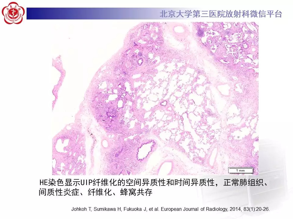 【病例】干燥综合征相关寻常型间质性肺炎1例CT影像表现