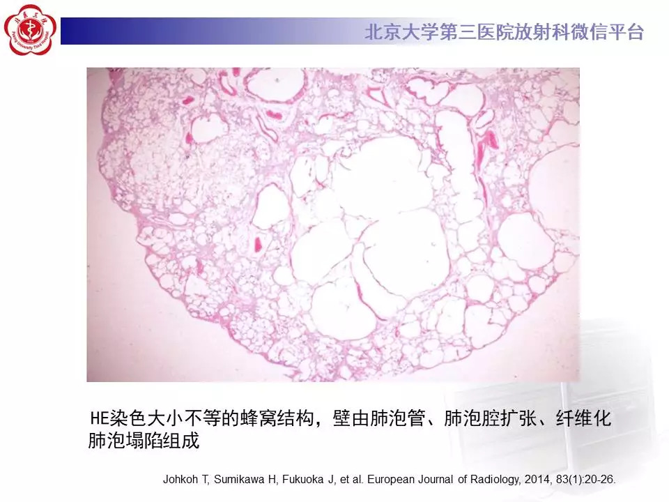 【病例】干燥综合征相关寻常型间质性肺炎1例CT影像表现