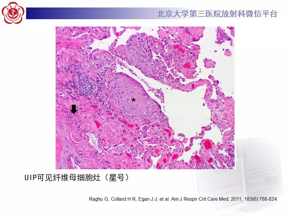 【病例】干燥综合征相关寻常型间质性肺炎1例CT影像表现