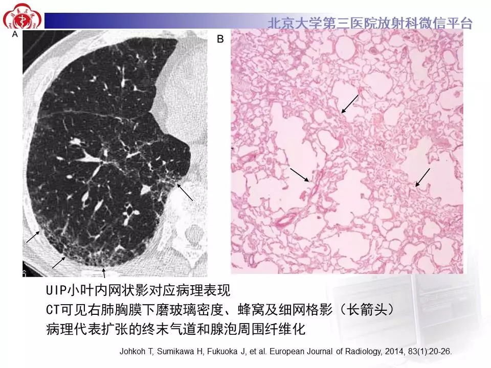【病例】干燥综合征相关寻常型间质性肺炎1例CT影像表现