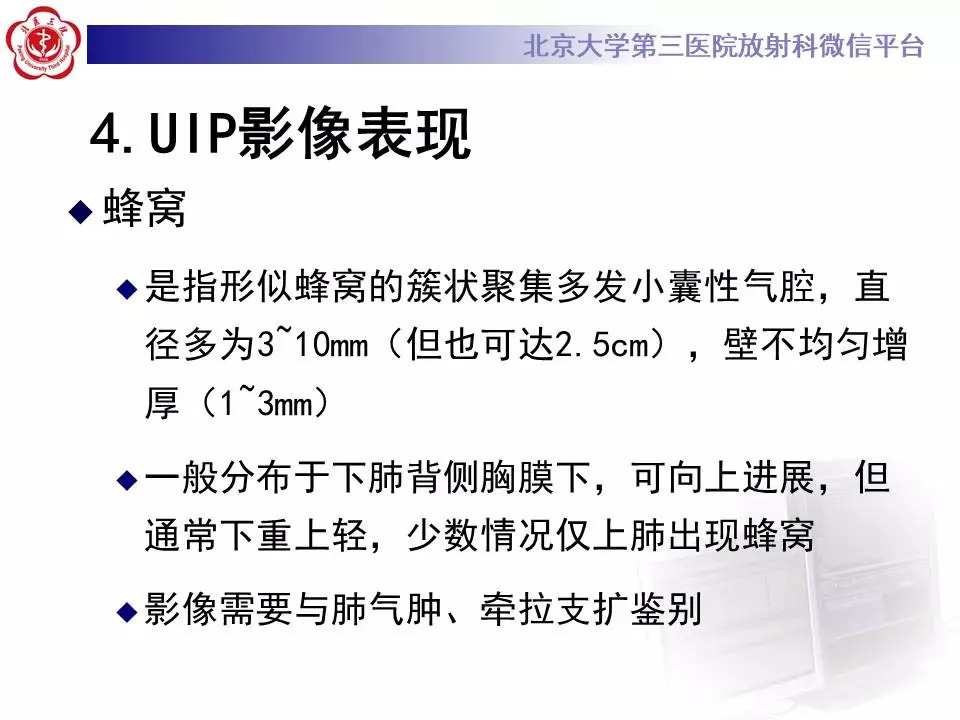 【病例】干燥综合征相关寻常型间质性肺炎1例CT影像表现