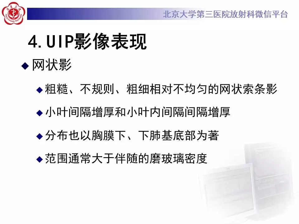【病例】干燥综合征相关寻常型间质性肺炎1例CT影像表现