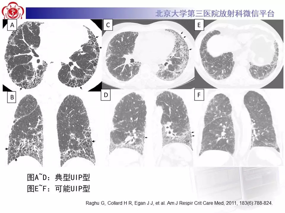 【病例】干燥综合征相关寻常型间质性肺炎1例CT影像表现