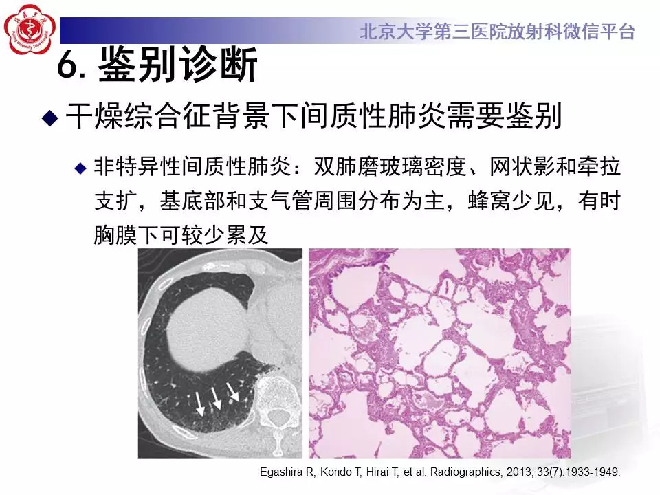 【病例】干燥综合征相关寻常型间质性肺炎1例CT影像表现