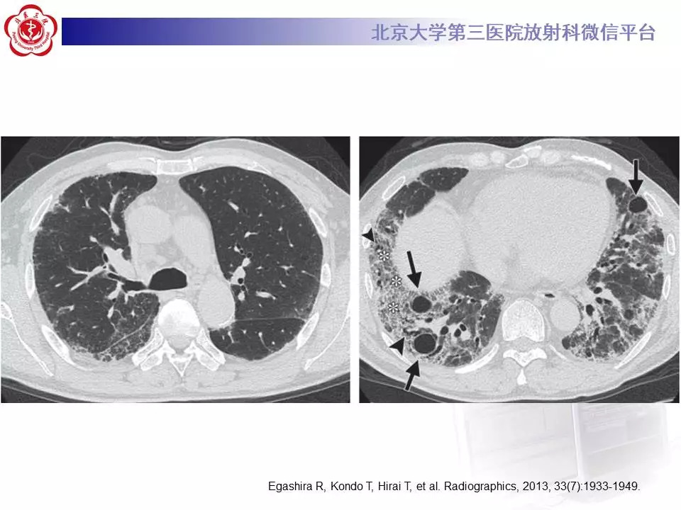 【病例】干燥综合征相关寻常型间质性肺炎1例CT影像表现