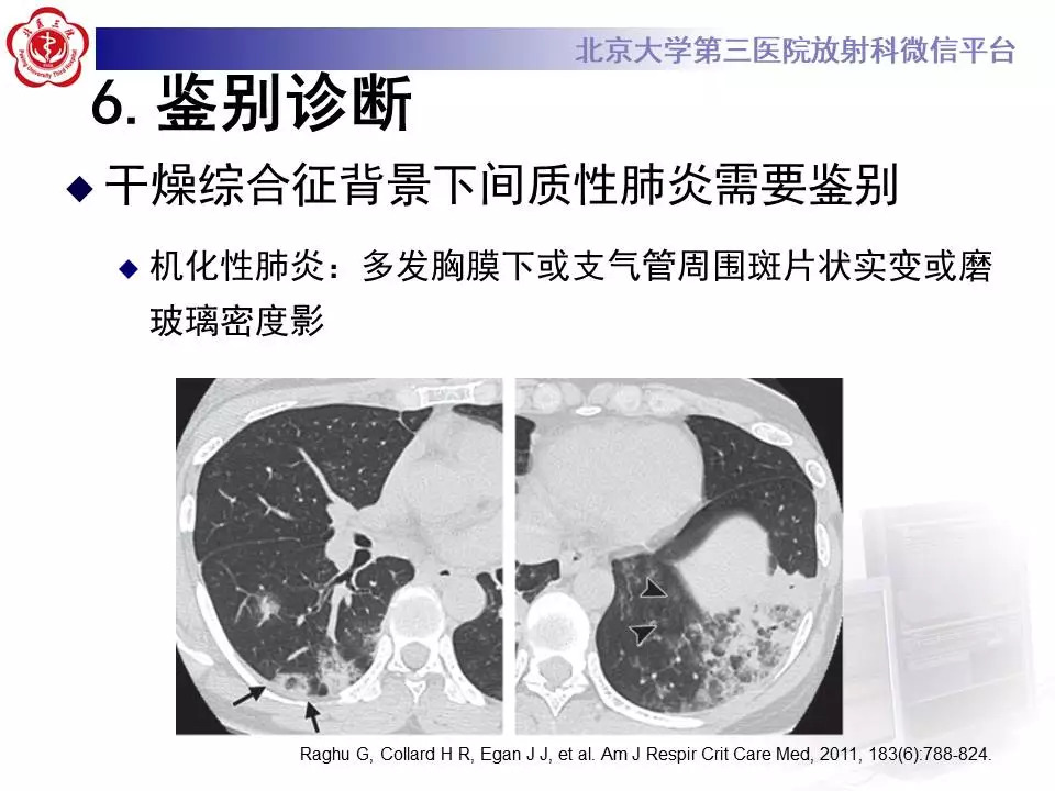 【病例】干燥综合征相关寻常型间质性肺炎1例CT影像表现