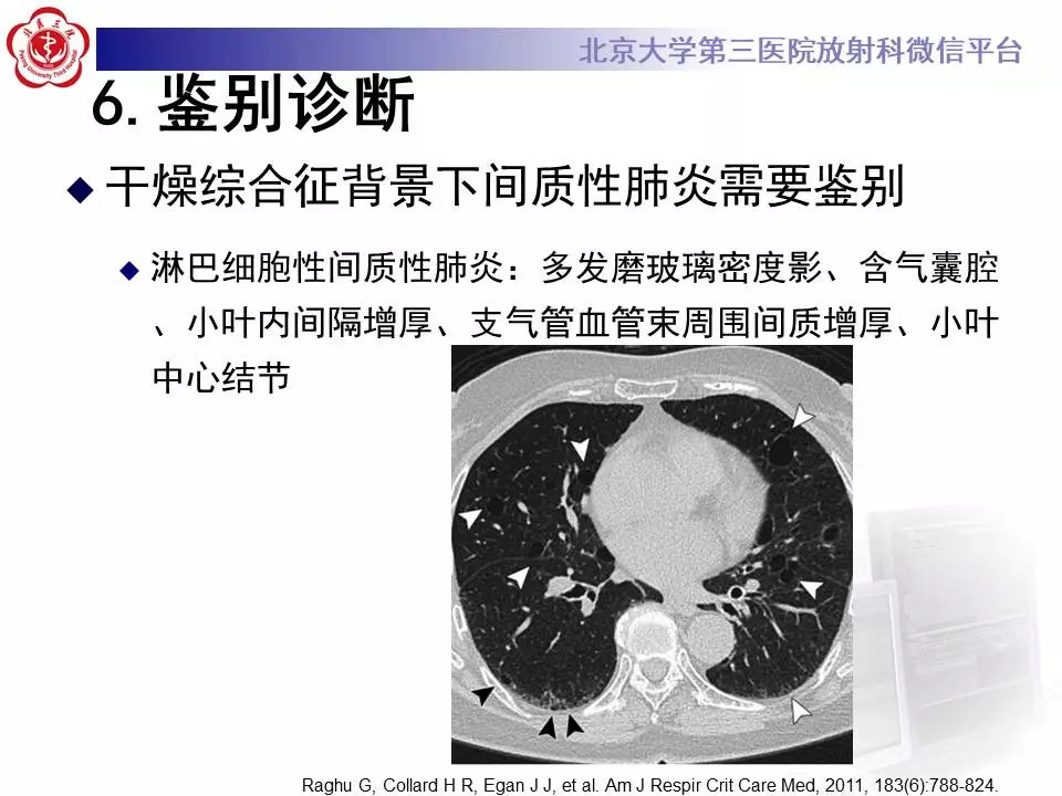 【病例】干燥综合征相关寻常型间质性肺炎1例CT影像表现