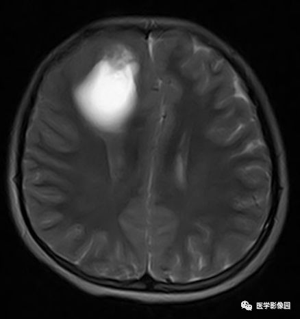 【病例】右额叶室管膜瘤1例MR影像表现 【病例】右额叶室管膜瘤1例MR影像表现
