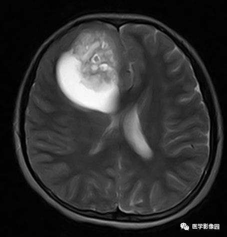 【病例】右额叶室管膜瘤1例MR影像表现 【病例】右额叶室管膜瘤1例MR影像表现