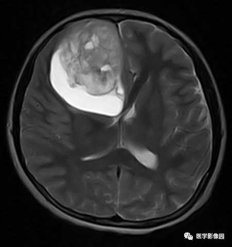 【病例】右额叶室管膜瘤1例MR影像表现 【病例】右额叶室管膜瘤1例MR影像表现