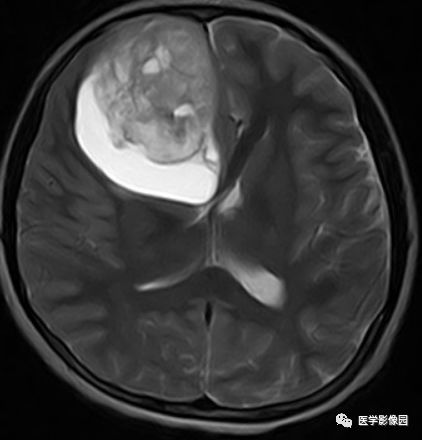 【病例】右额叶室管膜瘤1例MR影像表现 【病例】右额叶室管膜瘤1例MR影像表现