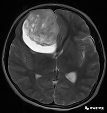 【病例】右额叶室管膜瘤1例MR影像表现 【病例】右额叶室管膜瘤1例MR影像表现