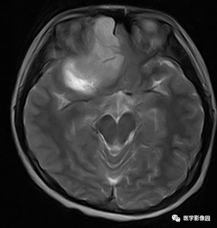 【病例】右额叶室管膜瘤1例MR影像表现 【病例】右额叶室管膜瘤1例MR影像表现