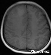 【病例】右额叶室管膜瘤1例MR影像表现 【病例】右额叶室管膜瘤1例MR影像表现