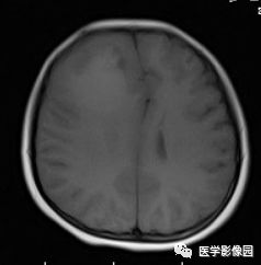 【病例】右额叶室管膜瘤1例MR影像表现 【病例】右额叶室管膜瘤1例MR影像表现