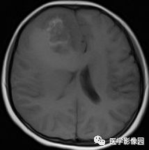 【病例】右额叶室管膜瘤1例MR影像表现 【病例】右额叶室管膜瘤1例MR影像表现