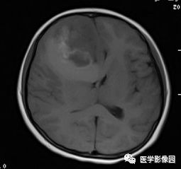 【病例】右额叶室管膜瘤1例MR影像表现 【病例】右额叶室管膜瘤1例MR影像表现