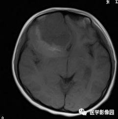 【病例】右额叶室管膜瘤1例MR影像表现 【病例】右额叶室管膜瘤1例MR影像表现