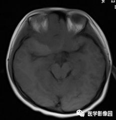【病例】右额叶室管膜瘤1例MR影像表现 【病例】右额叶室管膜瘤1例MR影像表现