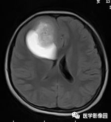 【病例】右额叶室管膜瘤1例MR影像表现 【病例】右额叶室管膜瘤1例MR影像表现