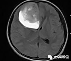 【病例】右额叶室管膜瘤1例MR影像表现 【病例】右额叶室管膜瘤1例MR影像表现