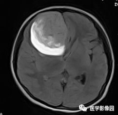 【病例】右额叶室管膜瘤1例MR影像表现 【病例】右额叶室管膜瘤1例MR影像表现