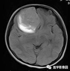【病例】右额叶室管膜瘤1例MR影像表现 【病例】右额叶室管膜瘤1例MR影像表现