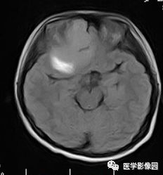 【病例】右额叶室管膜瘤1例MR影像表现 【病例】右额叶室管膜瘤1例MR影像表现