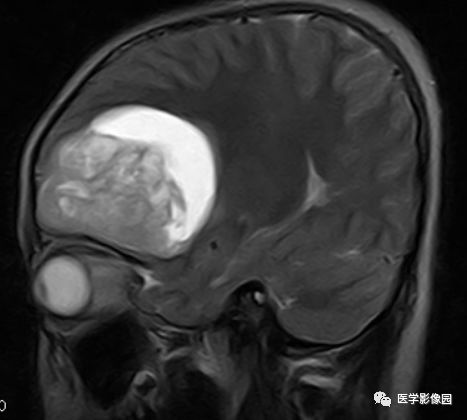 【病例】右额叶室管膜瘤1例MR影像表现 【病例】右额叶室管膜瘤1例MR影像表现