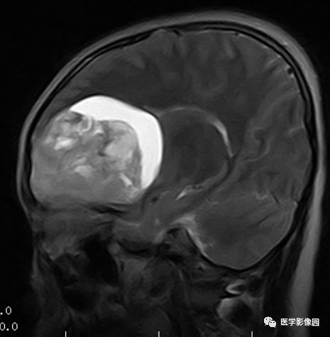 【病例】右额叶室管膜瘤1例MR影像表现 【病例】右额叶室管膜瘤1例MR影像表现